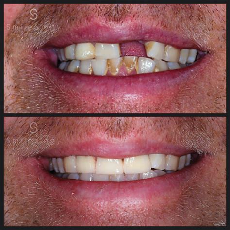 full-mouth implant in kent|Dental Implants Kent .